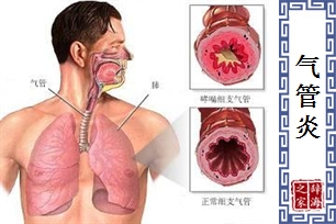 气管炎