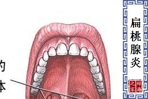 扁桃腺炎