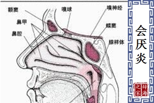 会厌炎