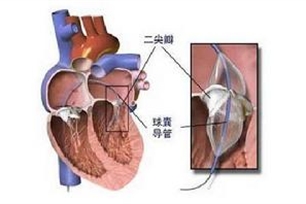 二尖瓣